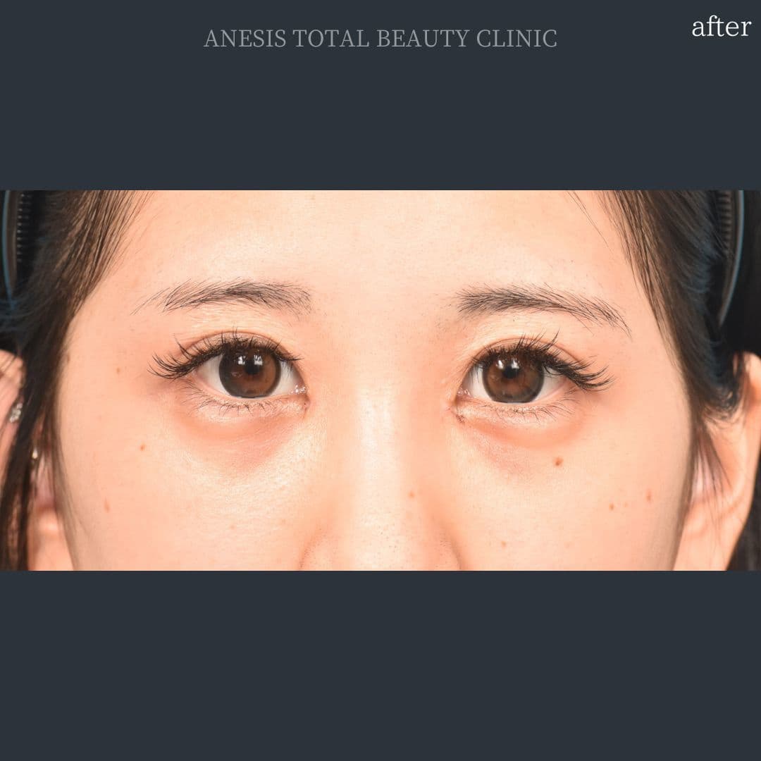 目頭切開アフター