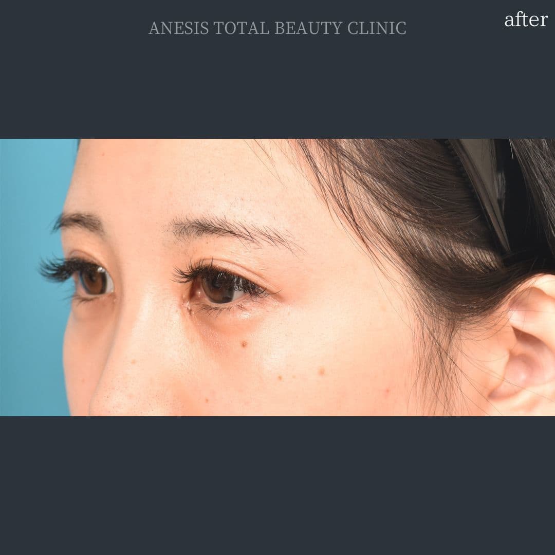 目頭切開アフター