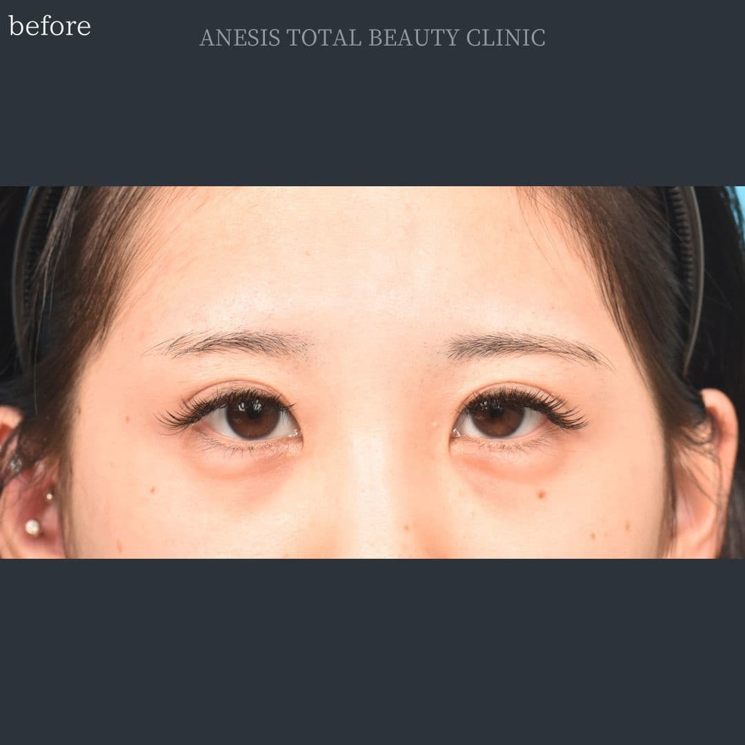 目頭切開ビフォー