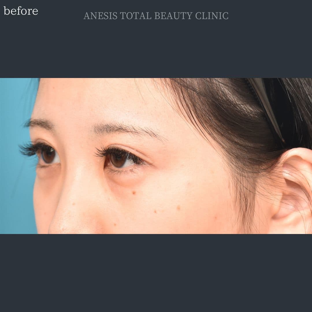 目頭切開ビフォー