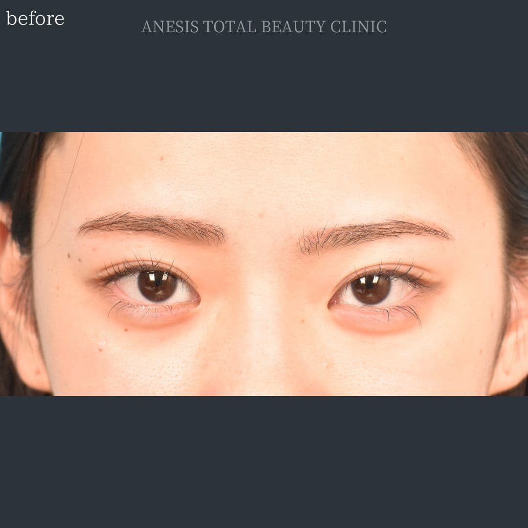 目頭切開ビフォー