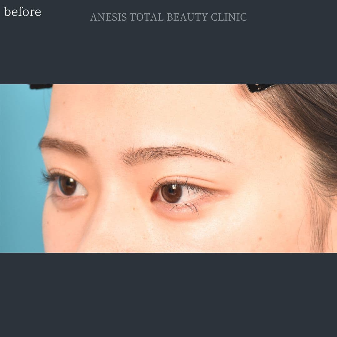 目頭切開ビフォー