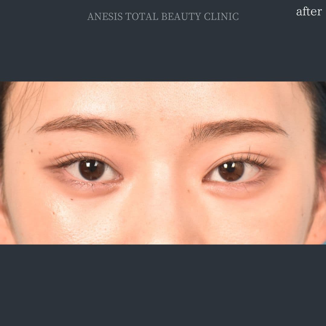 目頭切開アフター