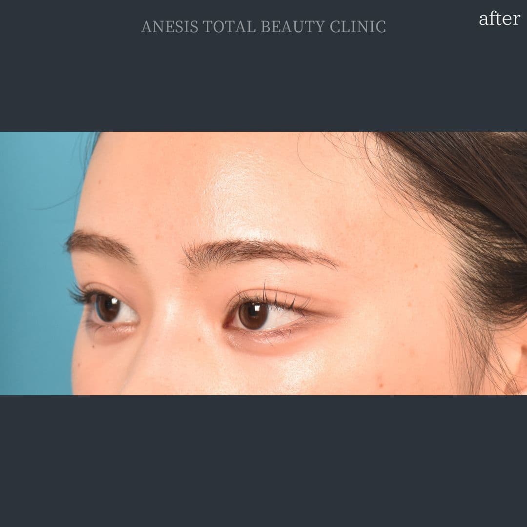 目頭切開アフター