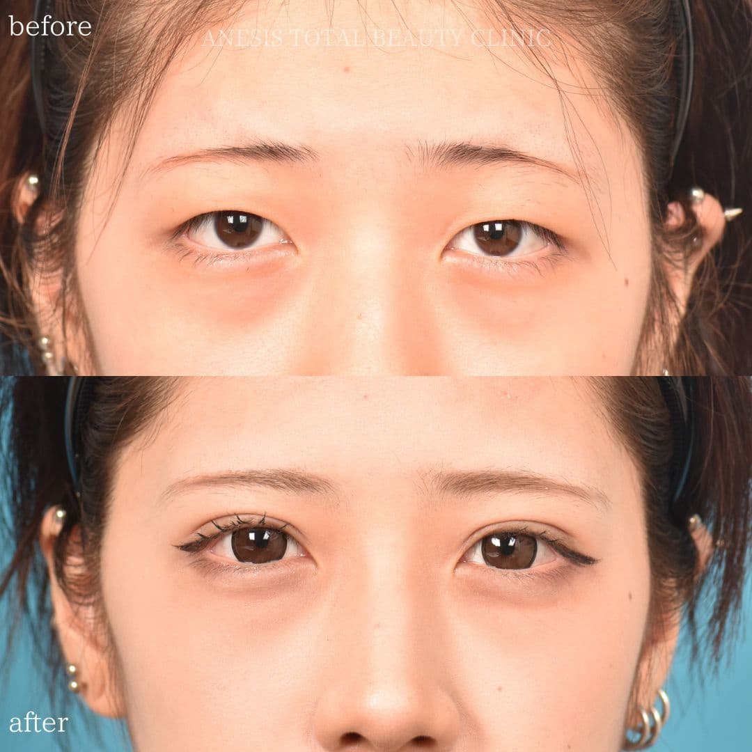 目整形ビフォーアフター