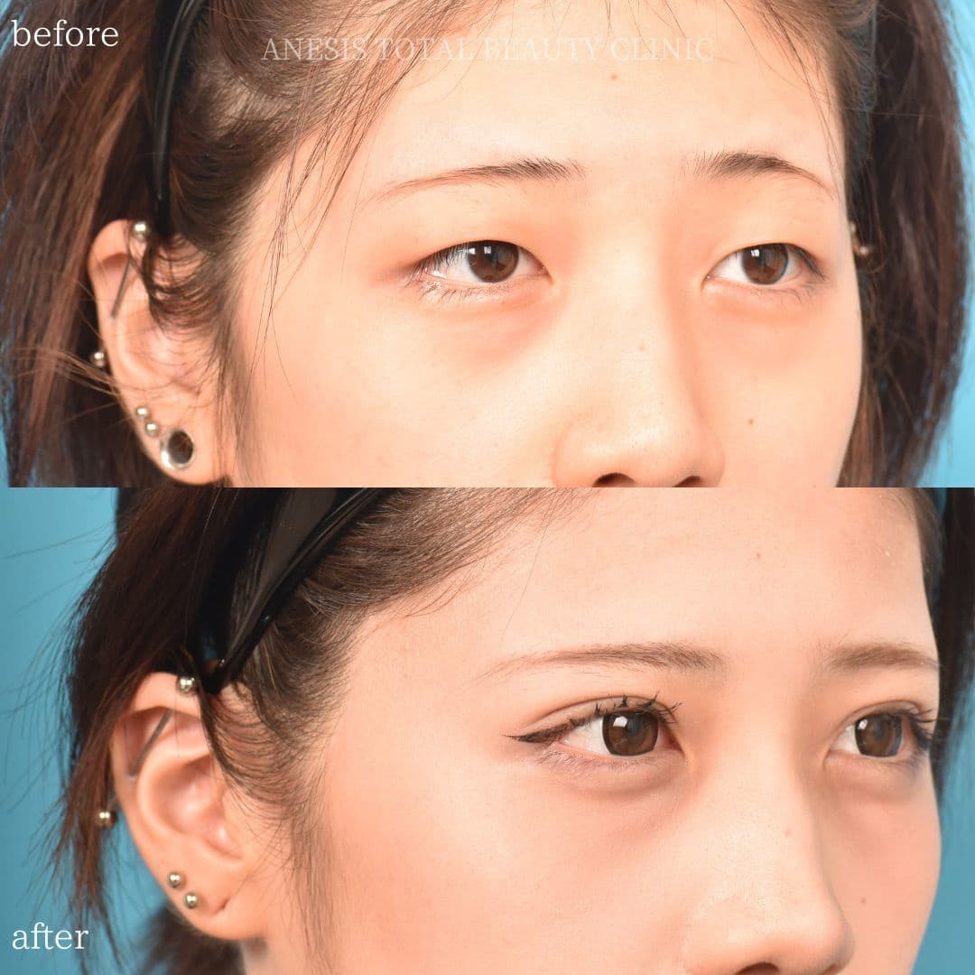 目整形ビフォーアフター