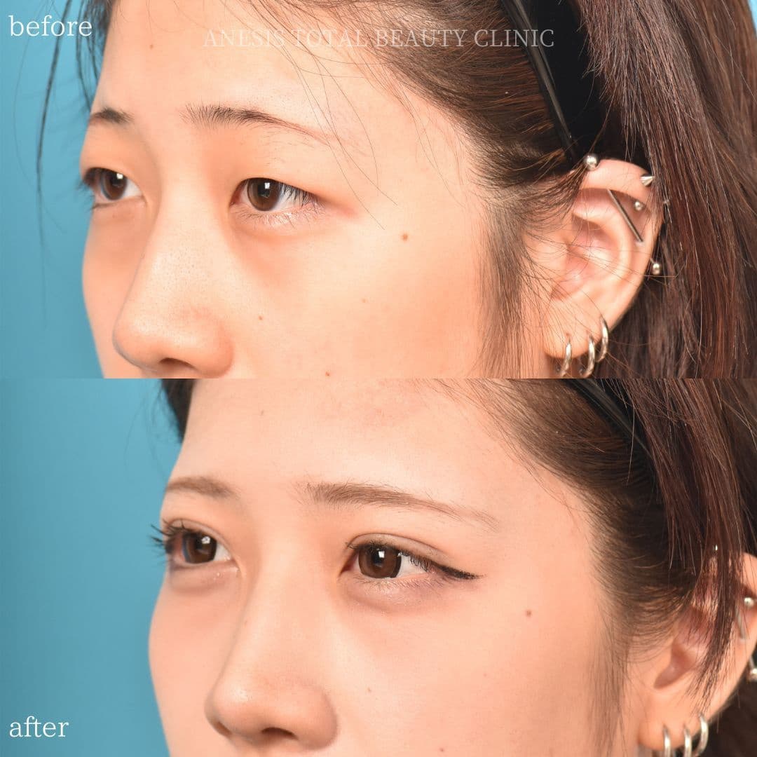 目整形ビフォーアフター