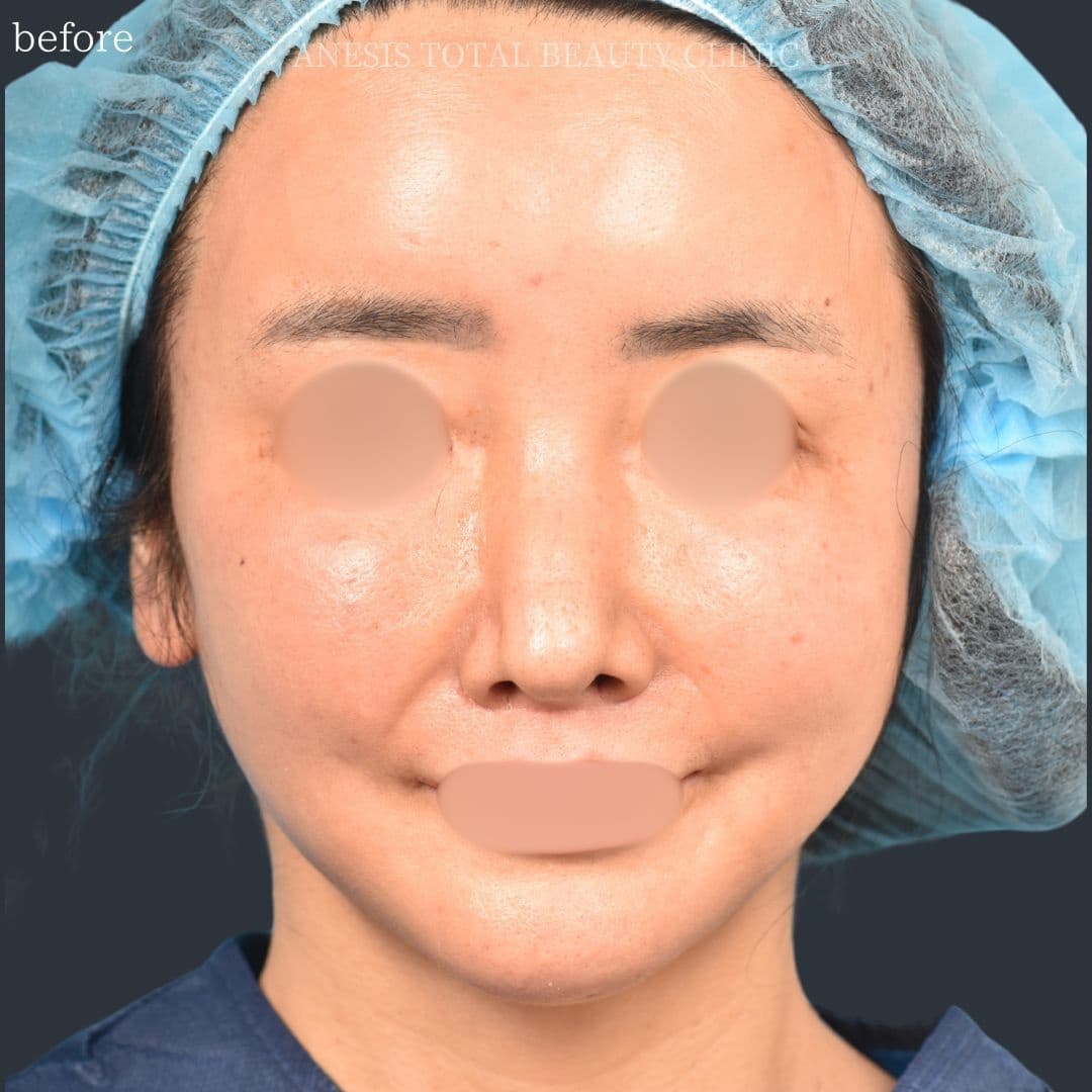 フェイスラインリフト症例