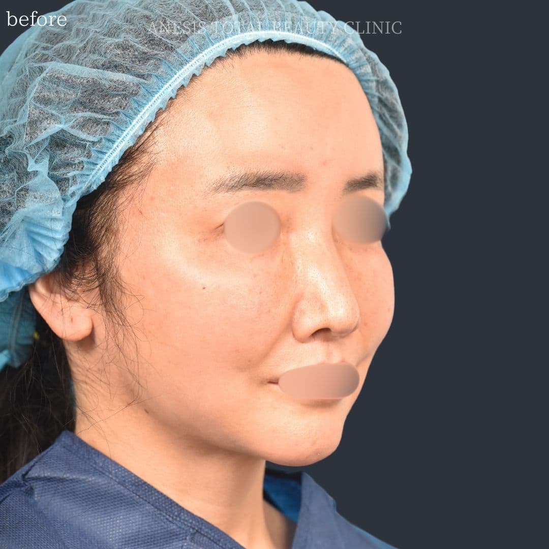 フェイスラインリフト症例