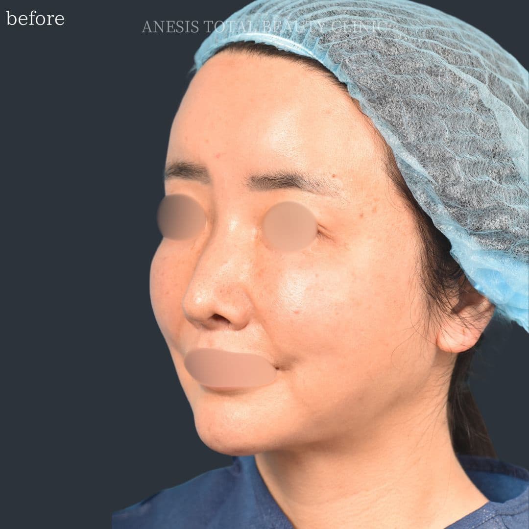 フェイスラインリフト症例