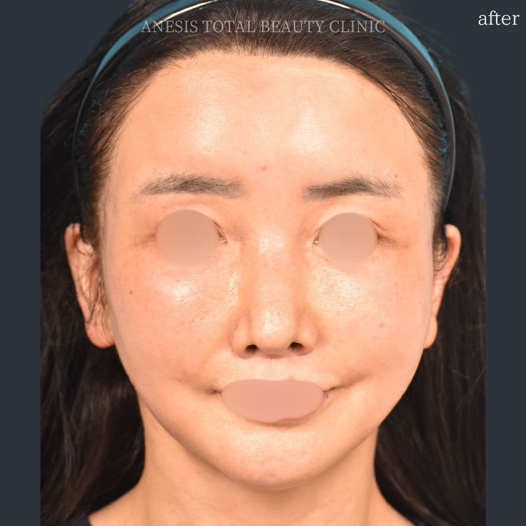 フェイスラインリフト症例