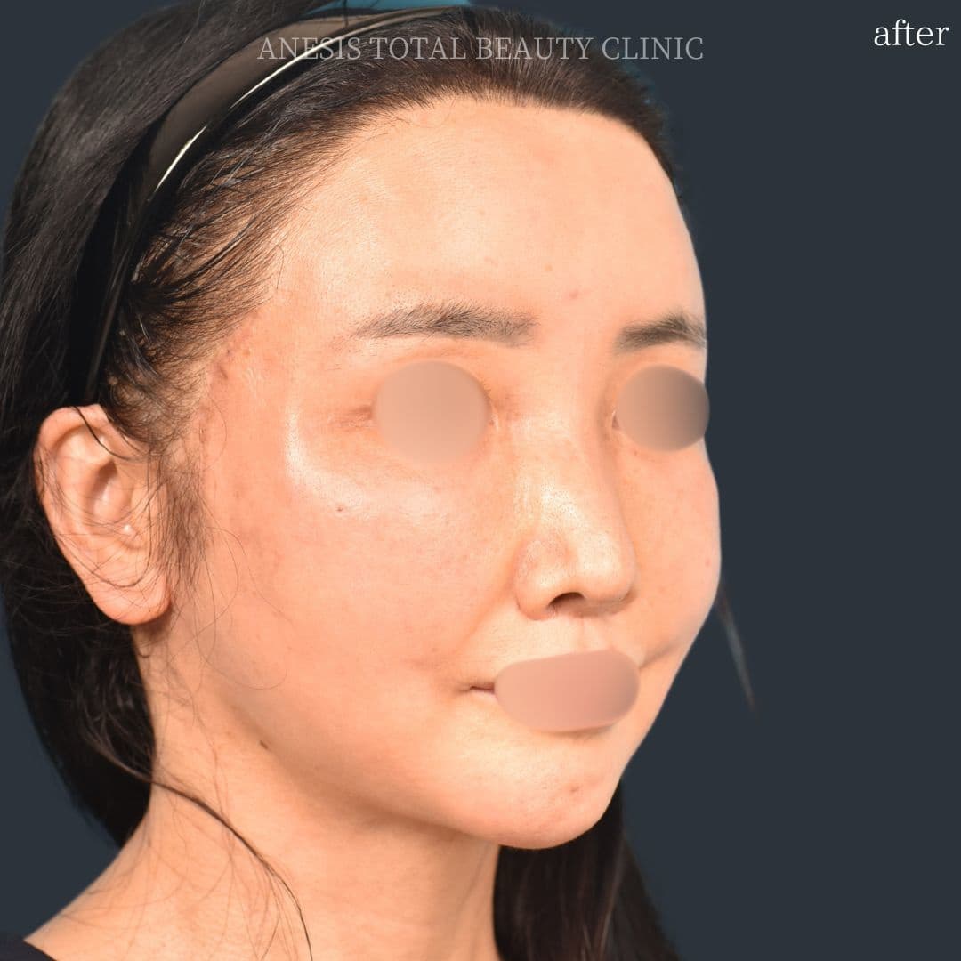 フェイスラインリフト症例