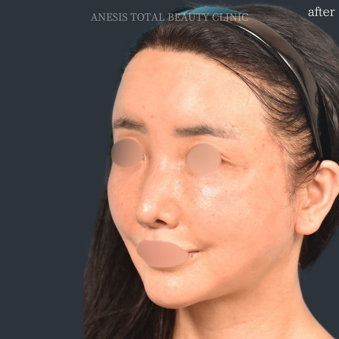 フェイスラインリフト症例