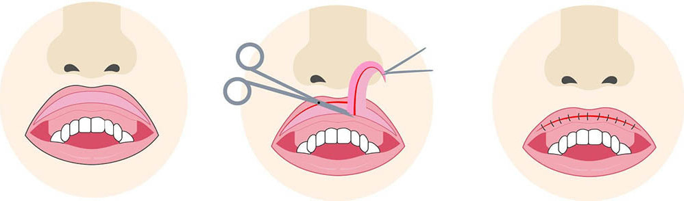 上口唇縮小
