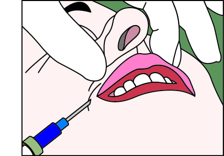 ヒアルロン酸注入