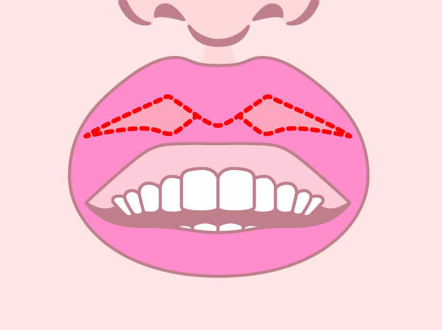 当院M字リップ手術