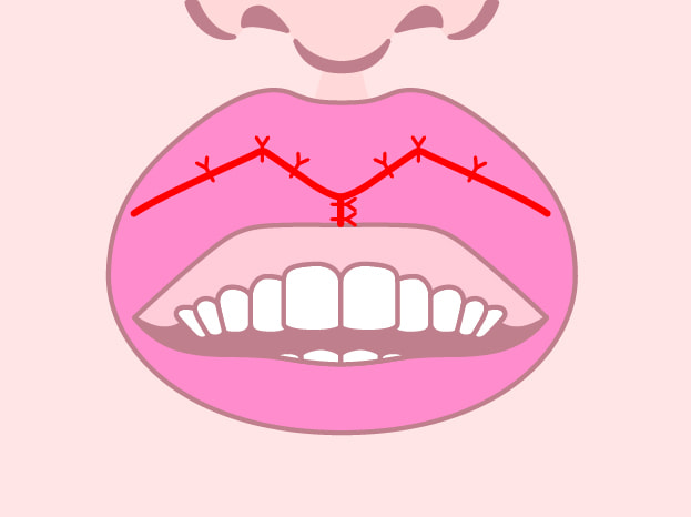 当院M字リップ手術