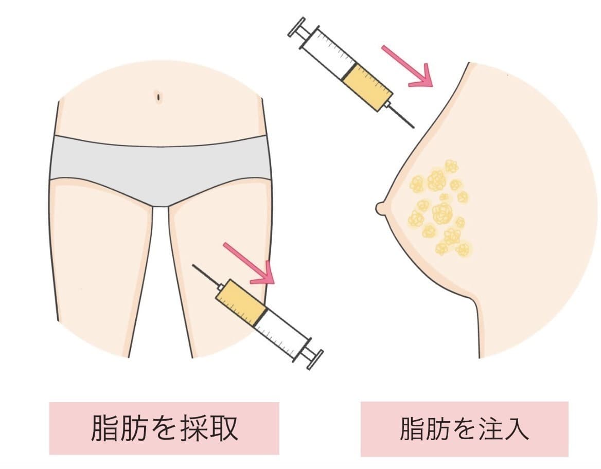 脂肪豊胸